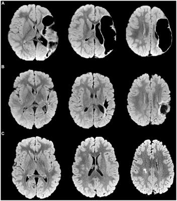 Neuroanatomical correlates of gross <mark class="highlighted">manual dexterity</mark> in children with unilateral spastic cerebral palsy